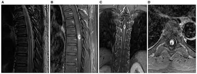 Diagnosis and Treatment of Spinal Syphilitic Gumma: A Case Report